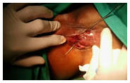 Cirugía de fístula anal en Puebla